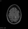 Neurosarcoidosis (Radiopaedia 10930-17204 Axial FLAIR 17).jpg