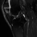 Non-displaced patella fracture (Radiopaedia 15932-15582 Sagittal T2 fat sat 9).jpg