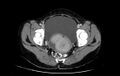 Non-puerperal uterine inversion (Radiopaedia 78343-91094 A 49).jpg