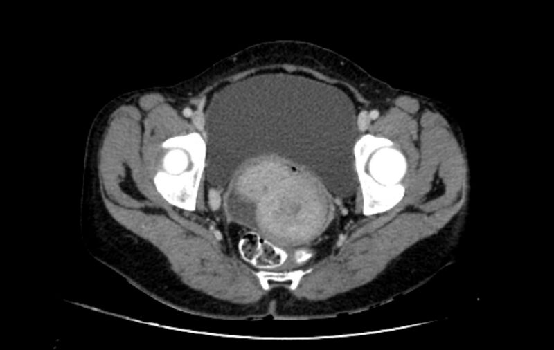 File:Non-puerperal uterine inversion (Radiopaedia 78343-91094 A 49).jpg