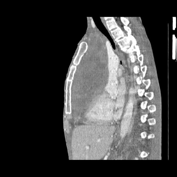 File:Non hodgkin lymphoma of the mediastinum (Radiopaedia 20814-20729 D 9).jpg