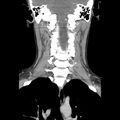 Normal CT of the neck (Radiopaedia 14575-14500 Coronal C+ 34).jpg