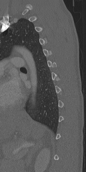 File:Normal CT thoracic spine (Radiopaedia 40181-42688 Sagittal bone window 13).png