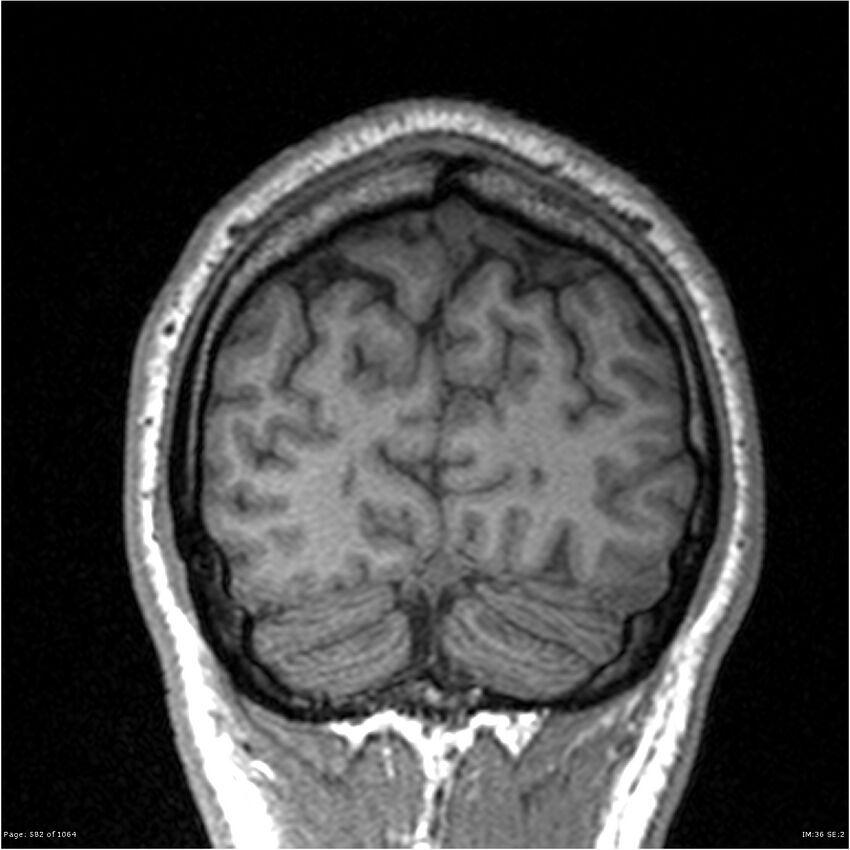 Normal brain MRI (non-focal epilepsy protocol) (Radiopaedia 38571-40700 Coronal T1 17).jpg