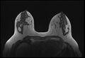 Normal breast MRI - dense breasts (Radiopaedia 80454-93850 Axial T1 94).jpg