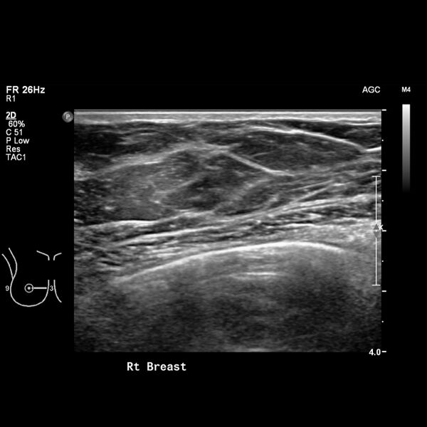 File:Normal breast mammography (tomosynthesis) and ultrasound (Radiopaedia 65325-74354 Right breast 4).jpeg