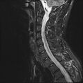 Normal cervical spine MRI (Radiopaedia 38418-40496 Sagittal STIR 9).jpg