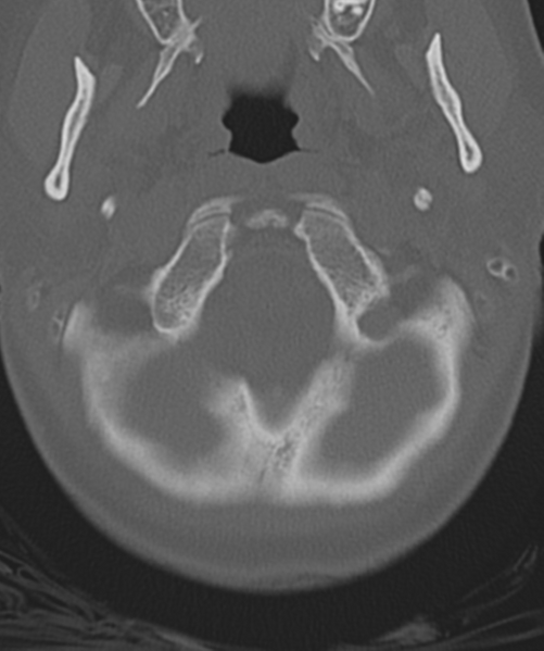 File:Normal cervical spine MRI (including Dixon) (Radiopaedia 42762-45926 Axial bone window 8).png