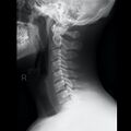 Normal cervical spine radiographs (Radiopaedia 32505-96698 Lateral 1).jpeg