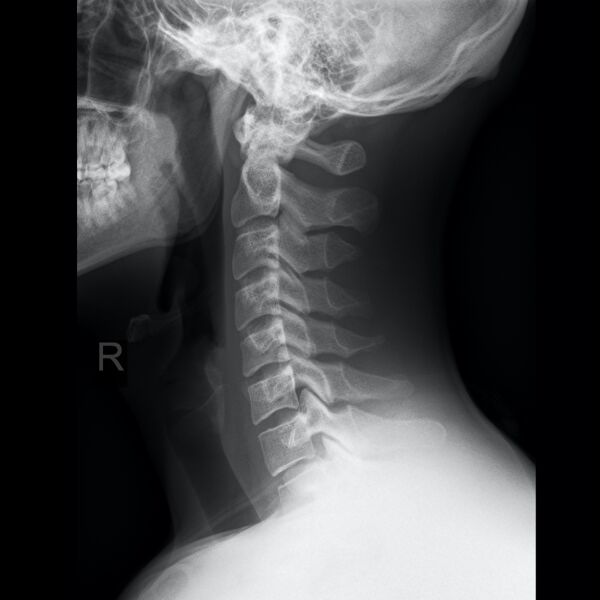File:Normal cervical spine radiographs (Radiopaedia 32505-96698 Lateral 1).jpeg