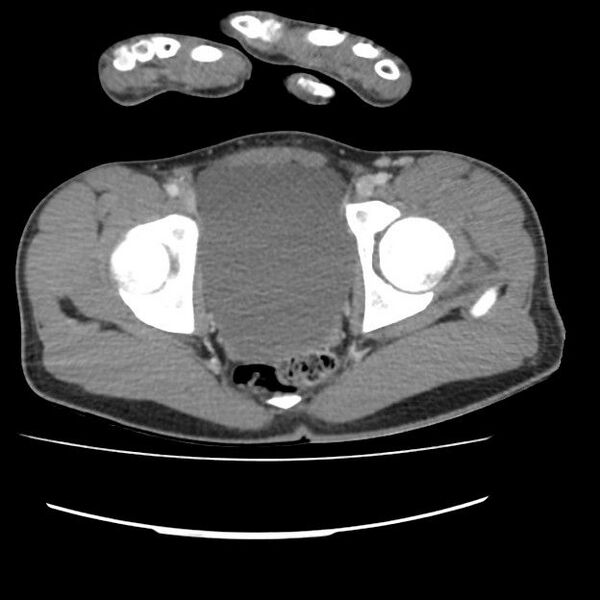 File:Normal dual-phase trauma CT chest,abdomen and pelvis (Radiopaedia 48092-52899 A 108).jpg