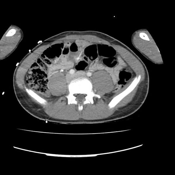 File:Normal dual-phase trauma CT chest,abdomen and pelvis (Radiopaedia 48092-52899 A 84).jpg