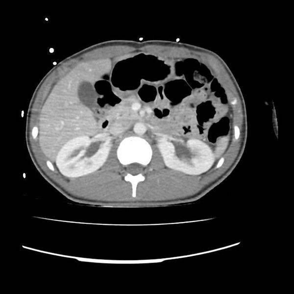 File:Normal dual-phase trauma CT chest,abdomen and pelvis (Radiopaedia 48092-52900 B 1).jpg