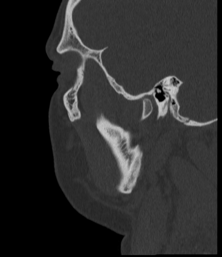 Normal facial bone CT (Radiopaedia 88742-105476 Sagittal bone window 131).jpg