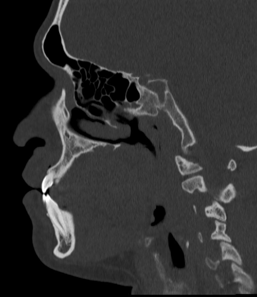 Normal facial bone CT (Radiopaedia 88742-105476 Sagittal bone window 76).jpg