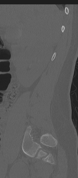 File:Normal lumbosacral CT (Radiopaedia 37923-39867 Sagittal bone window 83).png