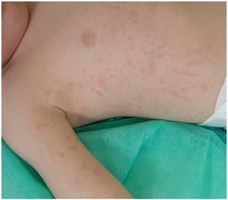 Salmon-macular rash (systemic juvenile idiopathic arthritis) - many red macules