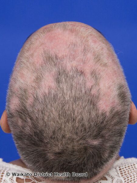 File:Systemic lupus erythematosus (DermNet NZ lupus-scalp).jpg
