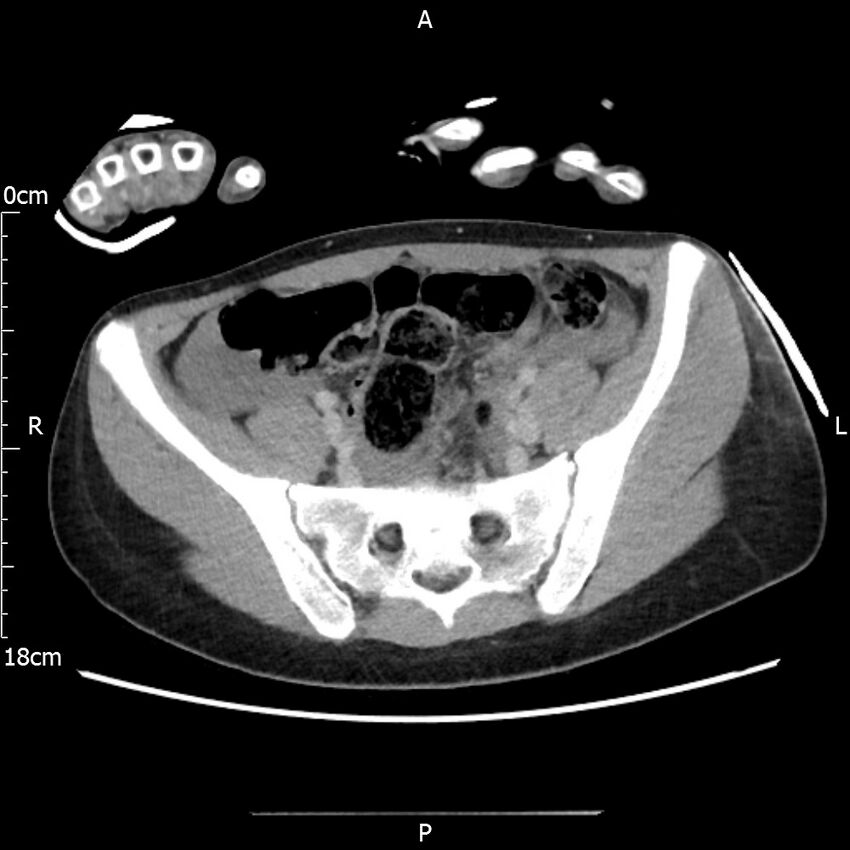 AAST grade IV kidney injury with CEUS follow-up (Radiopaedia 72353-82877 Axial C+ portal venous phase 57).jpg