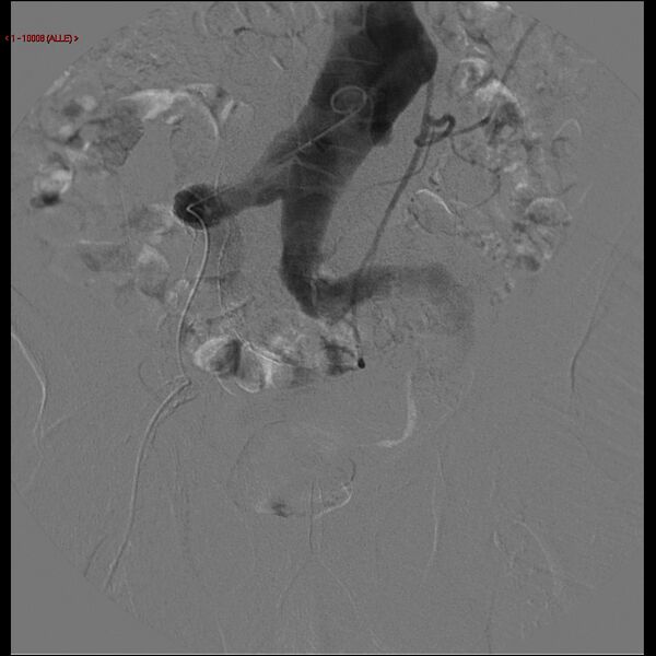 File:Abdominal aortic aneurysm (Radiopaedia 16155-15833 Frontal Aorta 4).jpg