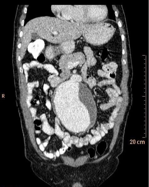 File:Abdominal aortic aneurysm (Radiopaedia 25985-26121 Coronal C+ arterial phase 8).jpg