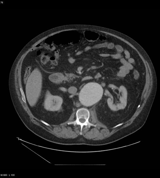 File:Abdominal aortic aneurysm with intramural hematoma then rupture (Radiopaedia 50278-55631 Axial C+ arterial phase 67).jpg