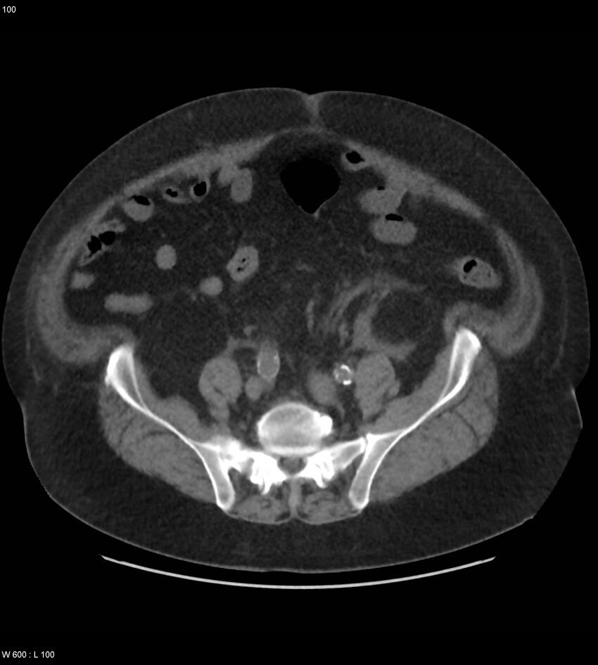 Abdominal aortic aneurysm with intramural hematoma then rupture (Radiopaedia 50278-55631 Axial non-contrast 96).jpg