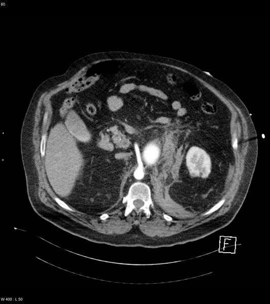 File:Abdominal aortic aneurysm with intramural hematoma then rupture (Radiopaedia 50278-55632 Axial C+ arterial phase 59).jpg