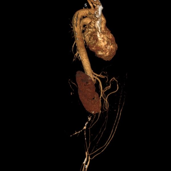 File:Abdominal aortic interposition tube graft and aneurysm thrombosis (Radiopaedia 71438-81857 3D VRT C+ arterial phase 13).jpg