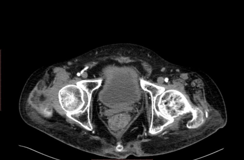 File:Abdominal aortic interposition tube graft and aneurysm thrombosis (Radiopaedia 71438-81857 Axial C+ arterial phase 233).jpg