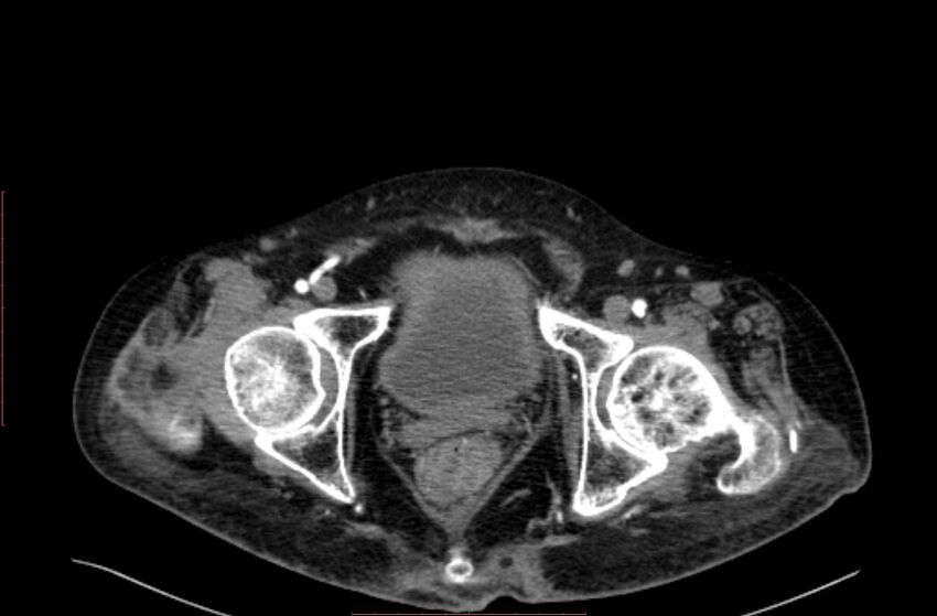 Abdominal aortic interposition tube graft and aneurysm thrombosis (Radiopaedia 71438-81857 Axial C+ arterial phase 233).jpg