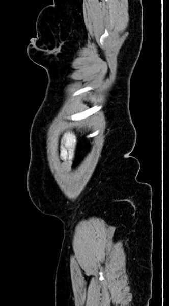 File:Abdominal hydatid disease (Radiopaedia 68223-77737 Sagittal C+ portal venous phase 2).jpg
