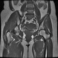 Abdominal wall endometriosis (Radiopaedia 83702-98847 Coronal T1 10).jpg