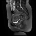 Abdominal wall endometriosis (Radiopaedia 83702-98847 Sagittal T2 fat sat 9).jpg