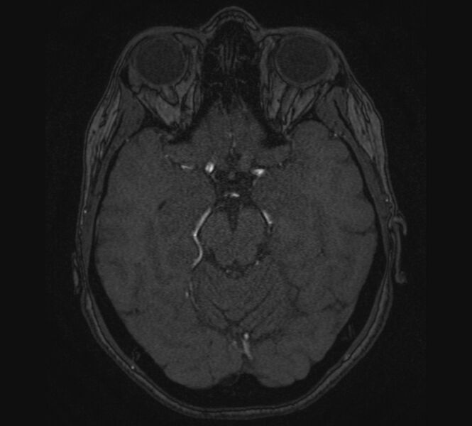 File:Accessory middle cerebral artery and ICA aneurysm (Radiopaedia 22656-22674 MRA 43).jpg