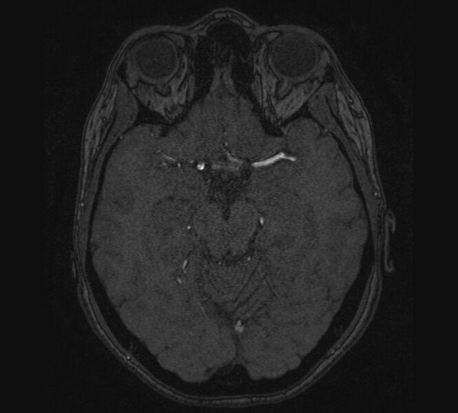 File:Accessory middle cerebral artery and ICA aneurysm (Radiopaedia 22656-22674 MRA 47).jpg