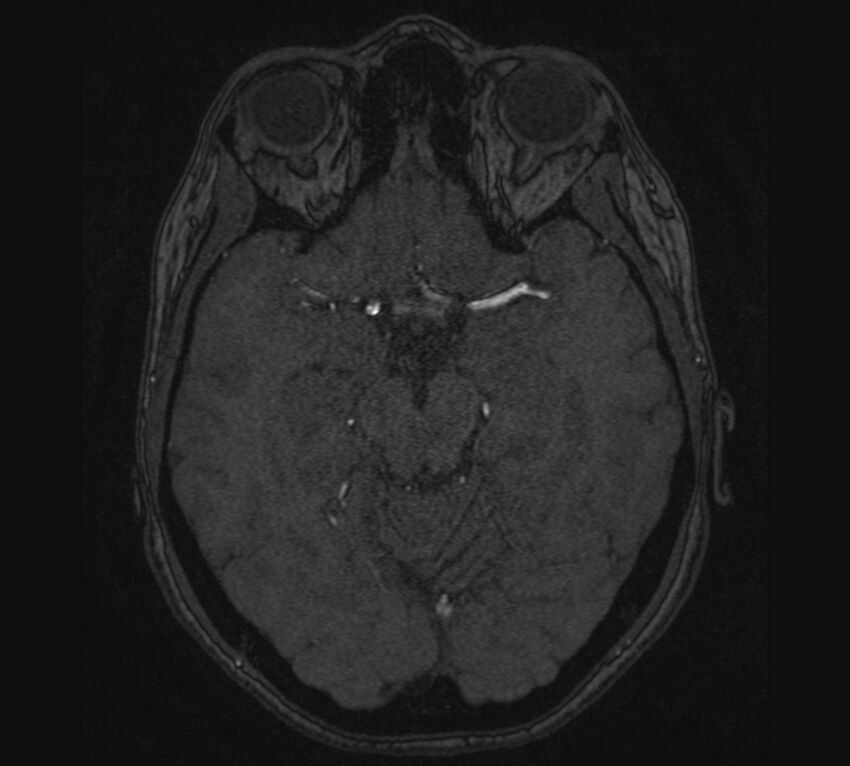 Accessory middle cerebral artery and ICA aneurysm (Radiopaedia 22656-22674 MRA 47).jpg