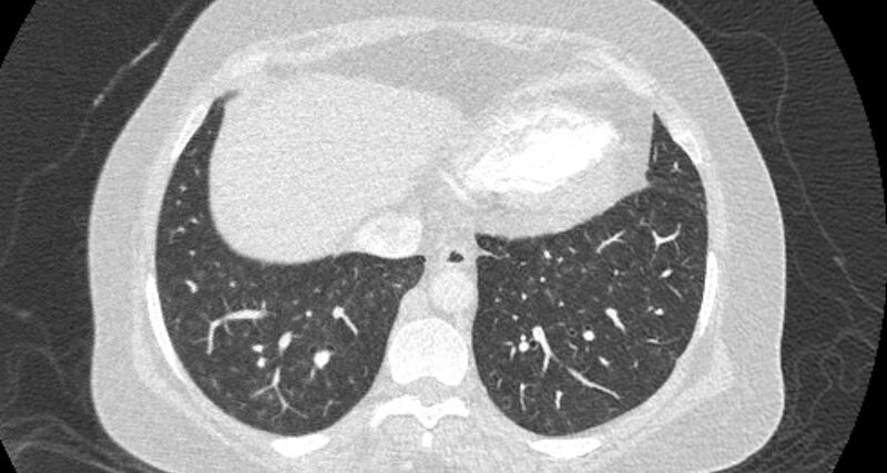 File:Accessory right inferior hepatic vein (Radiopaedia 65245-74259 Axial lung window 59).jpg