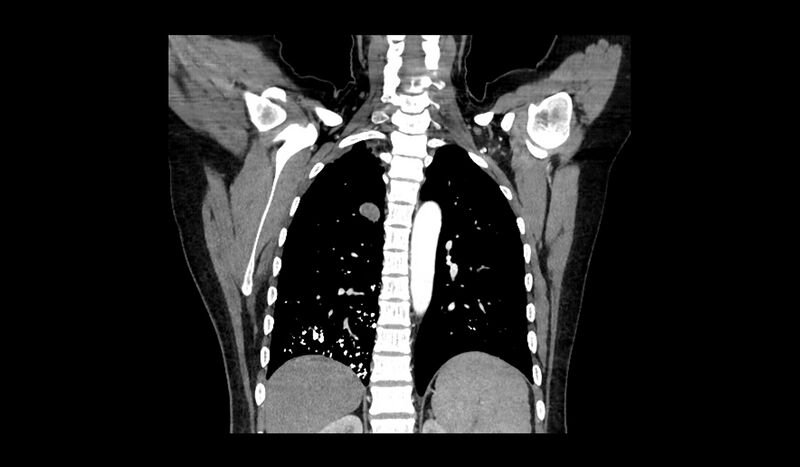 File:Acquired tracheo-esophageal fistula (Radiopaedia 51356-57103 Coronal C+ arterial phase 5).jpg
