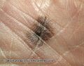 Acral lentiginous melanoma (DermNet NZ Acral-lentiginous-melanoma-3).jpg