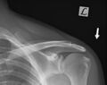 Acromioclavicular joint injury - Rockwood III (Radiopaedia 60196-67799 AP weight bearing 1).jpg