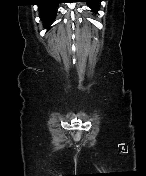 File:Active Crohn disease (Radiopaedia 59394-66750 Coronal C+ portal venous phase 63).jpg