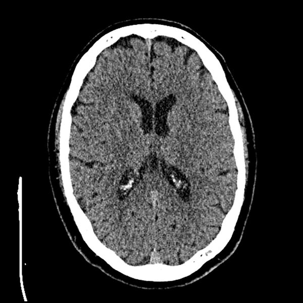 File:Acute A3 occlusion with ACA ischemic penumbra (CT perfusion) (Radiopaedia 72036-82525 Axial non-contrast thins 49).jpg