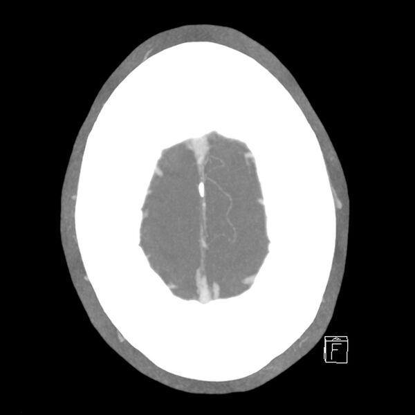 File:Acute A3 occlusion with ACA ischemic penumbra (CT perfusion) (Radiopaedia 72036-82527 Axial 10 sec delay thick MIP 4).jpg