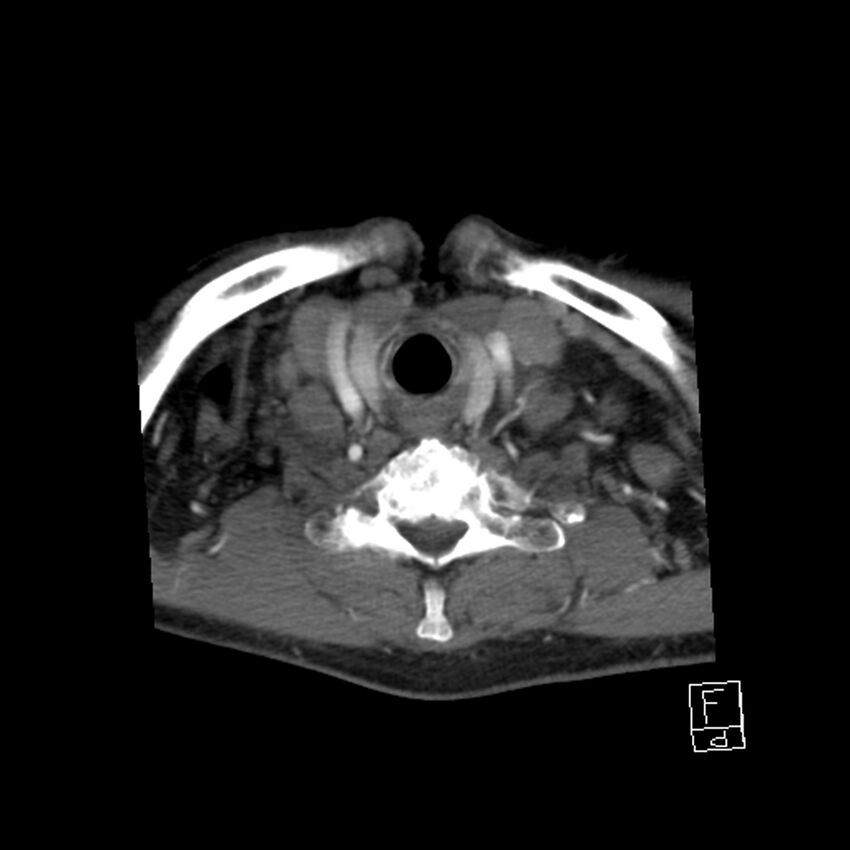 Acute ICA ischemic penumbra due to high-grade CCA stenosis (CT perfusion) (Radiopaedia 72038-82530 Axial C+ arterial phase 63).jpg