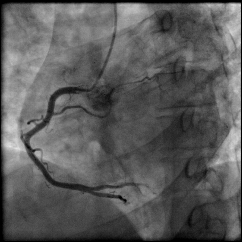 Acute anteroseptal myocardial infarction (Radiopaedia 68409-77946 RAO straight RCA 23).jpg