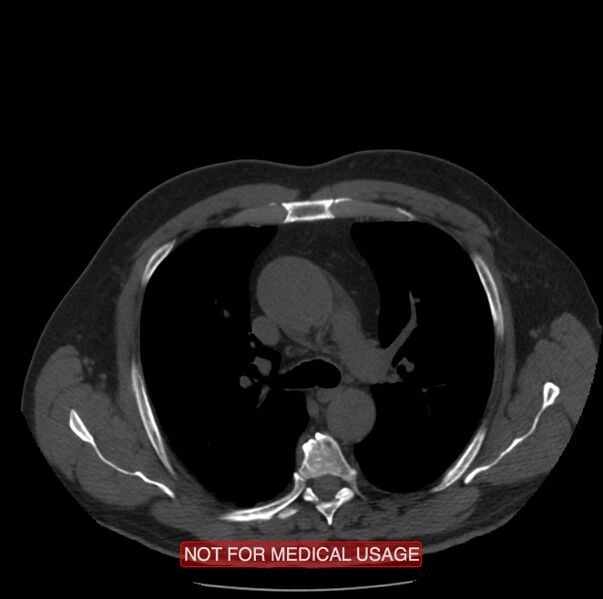 File:Acute aortic dissection - Stanford type A (Radiopaedia 40661-43285 Axial non-contrast 15).jpg