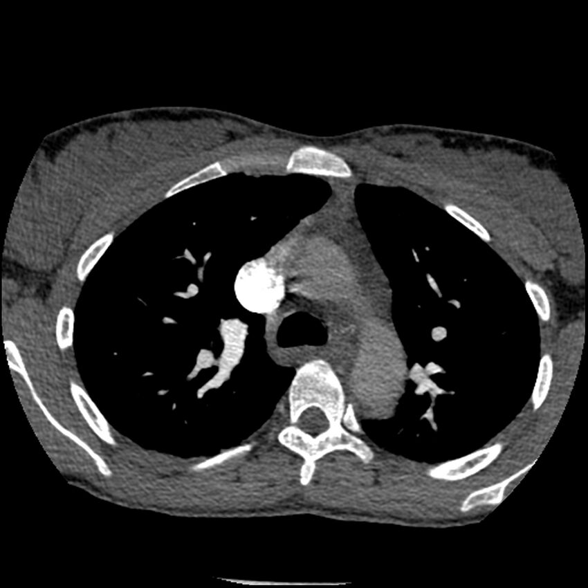 Acute chest syndrome - sickle cell disease (Radiopaedia 42375-45499 Axial C+ CTPA 63).jpg