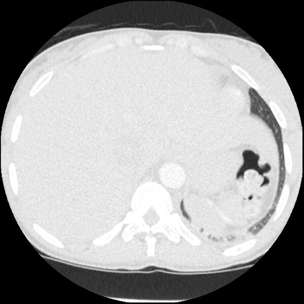 File:Acute chest syndrome - sickle cell disease (Radiopaedia 42375-45499 Axial lung window 170).jpg