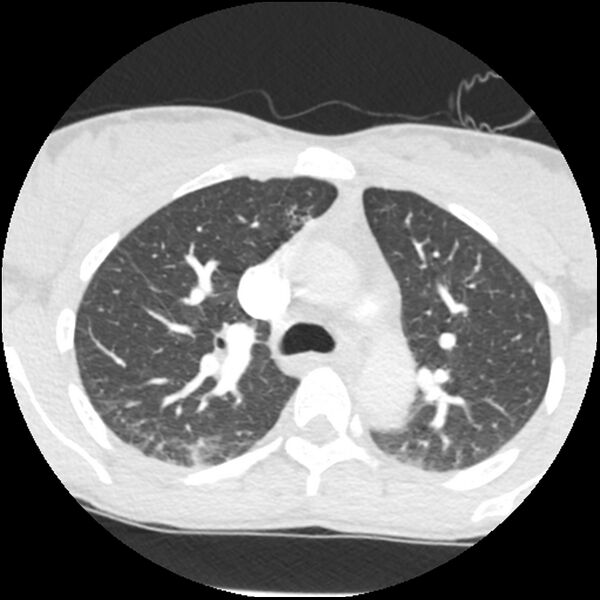 File:Acute chest syndrome - sickle cell disease (Radiopaedia 42375-45499 Axial lung window 66).jpg
